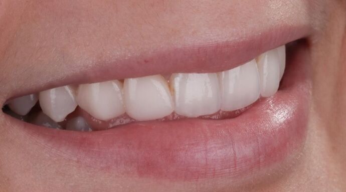 Smile Makeover & Veneers: Sammy. - Before