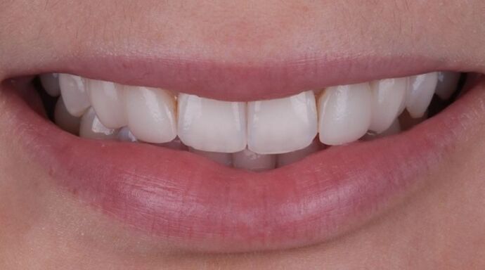 Smile Makeover & Veneers: Sammy. - Before