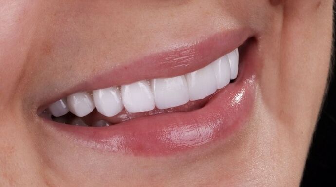 Smile Makeover & Veneers: Sammy. - After