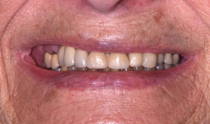 Full Mouth Rehabilitation with Crowns Case 2 - Before