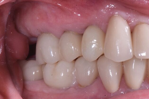 Full Mouth Rehabilitation with Crowns: Case 2 - After