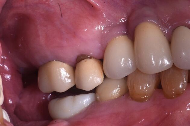 Full Mouth Rehabilitation with Crowns: Case 2 - Before