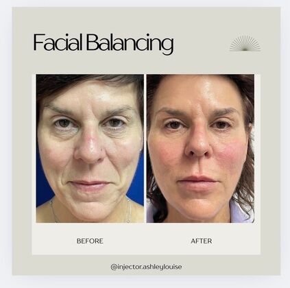 Injectables Botox, Dysport Neuromodulators: Case 12 (333315) - Before & After treatments