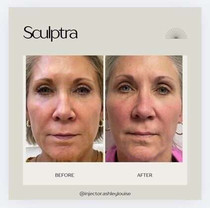 Injectables Botox, Dysport Neuromodulators: Case 13 (15743) - B & A series of Sculptra treatments