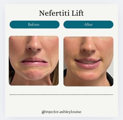 Injectables Botox, Dysport Neuromodulators: Case 14 (33449) - B&A selective treatment