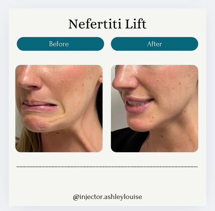 Injectables Botox, Dysport Neuromodulators: Case 14 (33449) - B&A lower face & neck