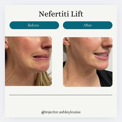 Injectables Botox, Dysport Neuromodulators: Case 14 (33449) - B&A “Nefertiti Lift