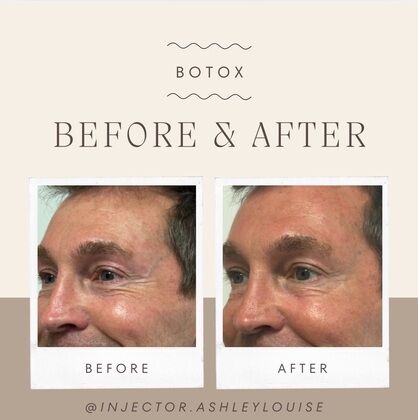 Injectables Botox, Dysport Neuromodulators: Case 15 (6735057) - Before & After