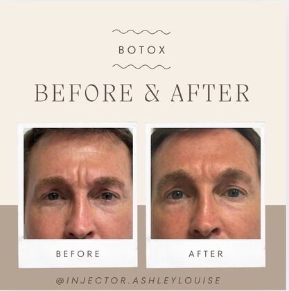 Injectables Botox, Dysport Neuromodulators: Case 15 (6735057) - Before & After