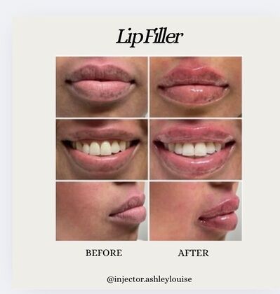 Injectables Botox, Dysport Neuromodulators: Case 16 (15743) - Before & After