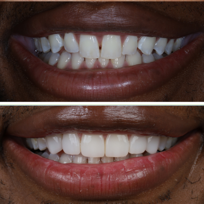 No Prep Porcelain Veneers Dananski - Before