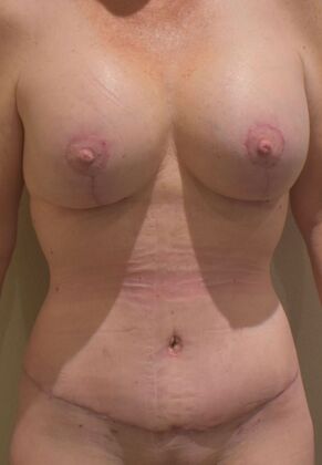 Massive Weight Loss : Case 195 - After