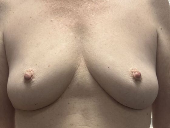Breast Augmentation w/ Lift: Case 98 - Before