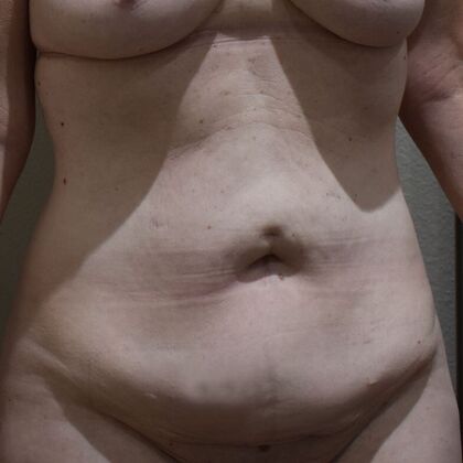 Tummy Tuck (Abdominoplasty): Case 564 - Before