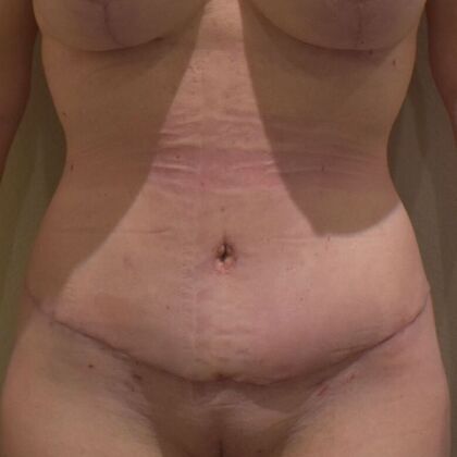 Tummy Tuck (Abdominoplasty): Case 564 - After
