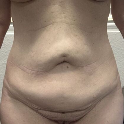 Tummy Tuck (Abdominoplasty): Case 564 - Before