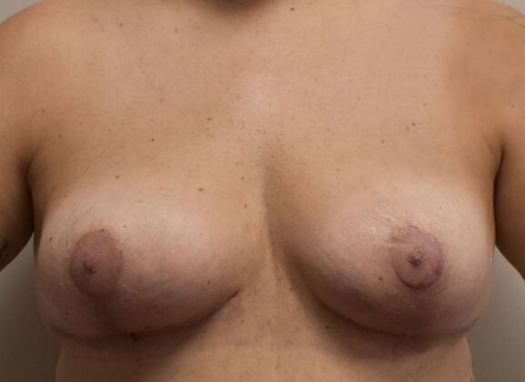 Breast Implant Removal: Case 64 - After