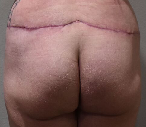 Buttock Lift Case 8 - After