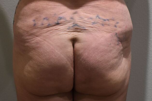 Buttock Lift Case 8 - Before