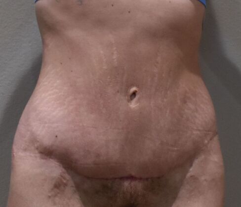 Massive Weight Loss  Case 196 - After