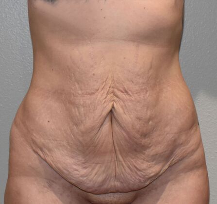 Massive Weight Loss  Case 196 - Before