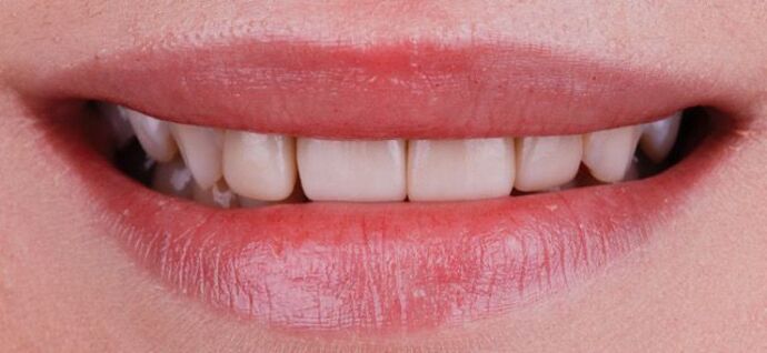 Smile Design Cases Case 15 - Before