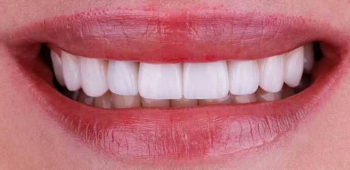 Smile Design Cases Case 15 - After