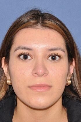 Rhinoplasty: Lovely patient 4 years after surgery - After