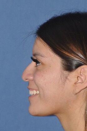 Rhinoplasty: Lovely patient 4 years after surgery - Before