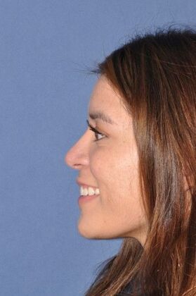 Rhinoplasty: Lovely patient 4 years after surgery - After