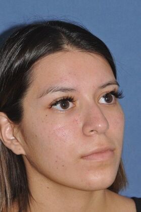 Rhinoplasty: Lovely patient 4 years after surgery - Before