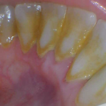 Dental Cleaning Case 1 - Before