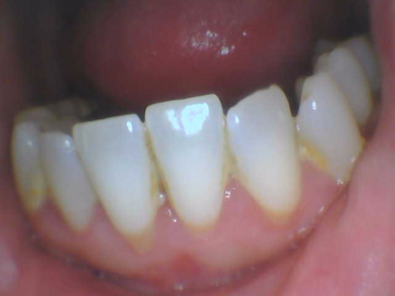 Dental Cleaning: Case 1 - Before