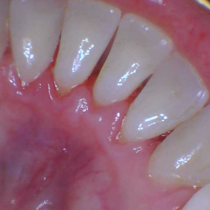 Dental Cleaning Case 1 - After