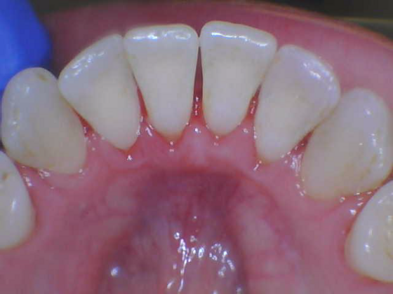 Dental Cleaning: Case 1 - After