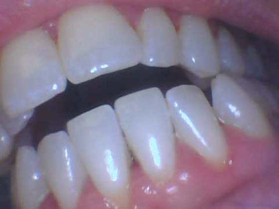 Dental Cleaning: Case 1 - After