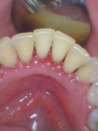 Periodontal Scaling and Root Planing Case 1 - After