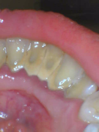 Periodontal Scaling and Root Planing Case 1 - Before