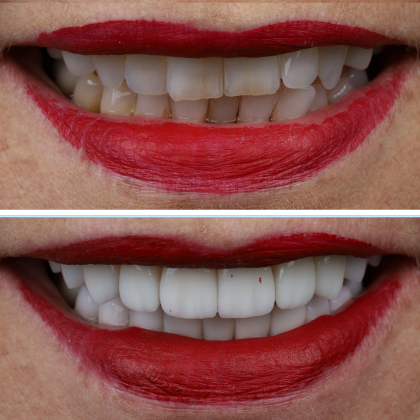 Minimal Prep Porcelain Veneers Wendy - Before