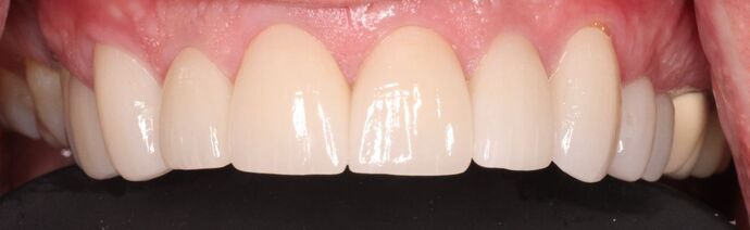 Smile Makeover Case 3 - After