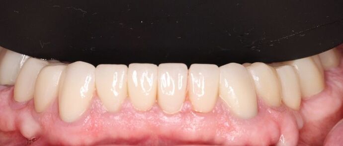 Smile Makeover: Case 3 - After