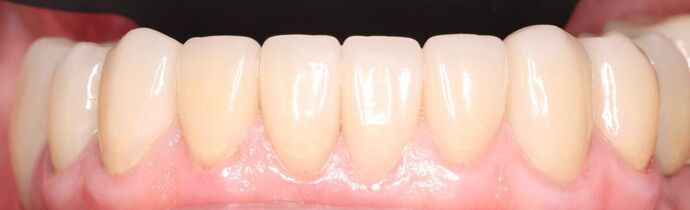 Smile Makeover: Case 3 - After