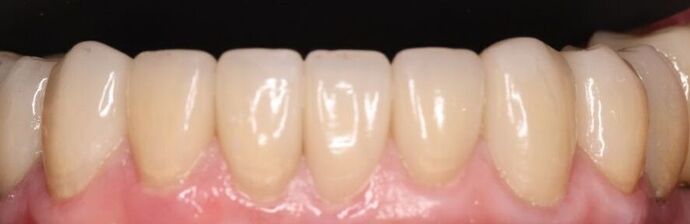 Smile Makeover: Case 3 - After