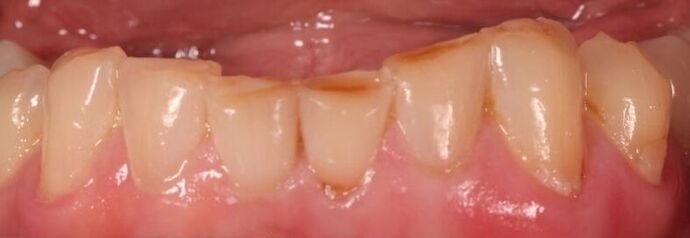 Smile Makeover: Case 3 - Before