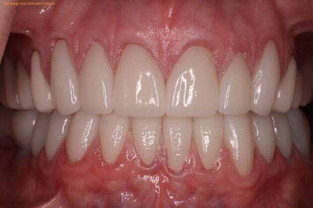 Smile Makeover: Case 3 - After