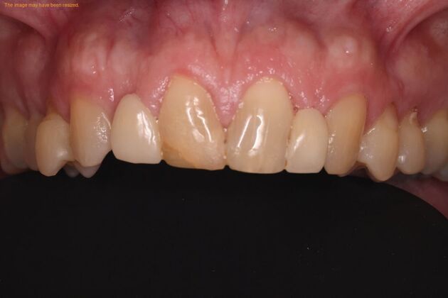 Smile Makeover: Case 3 - Before