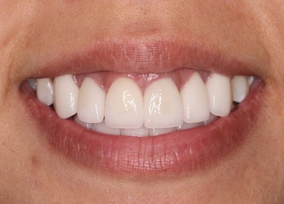 Smile Makeover: Case 3 - After