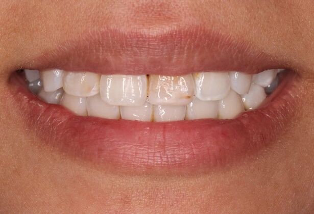 Smile Makeover: Case 3 - Before