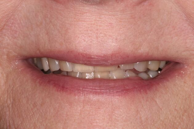 Smile Makeover: Case 3 - Before