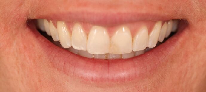 Smile Makeover: Case 3 - Before